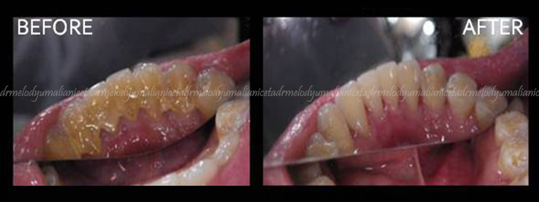 Oral Prophylaxis / Stain Removal 1