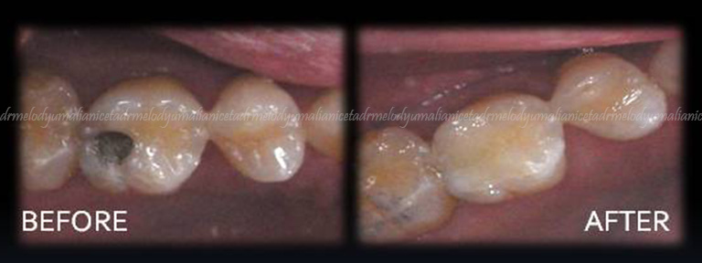 Amalgam Replacement 1