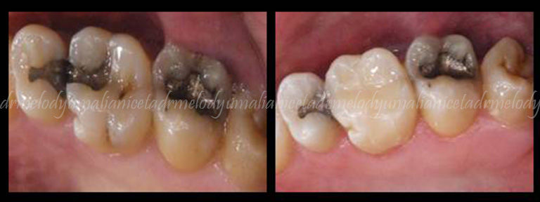 Amalgam Replacement 4