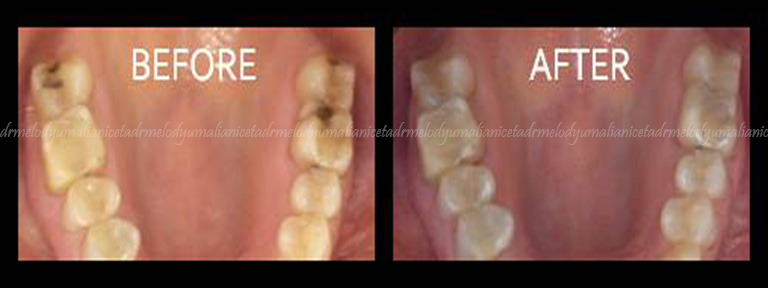 Amalgam Replacement 2