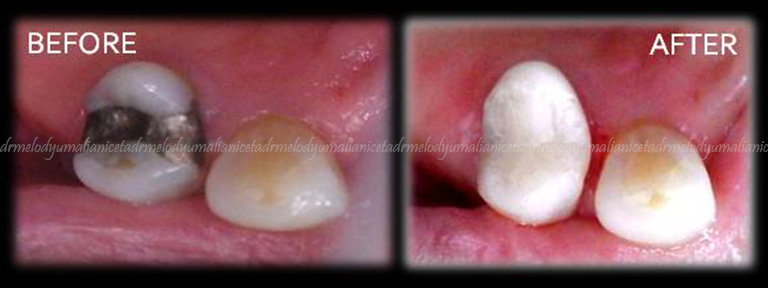 Amalgam Replacement 3