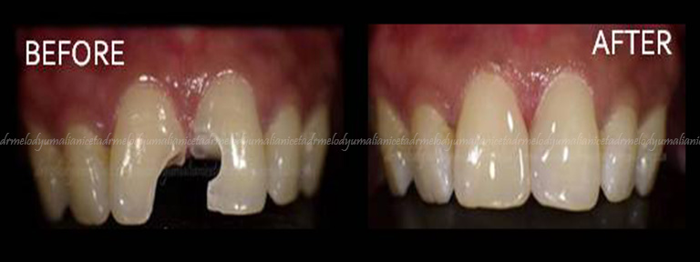 Dental Restoration 1