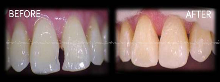 Dental Restoration 2