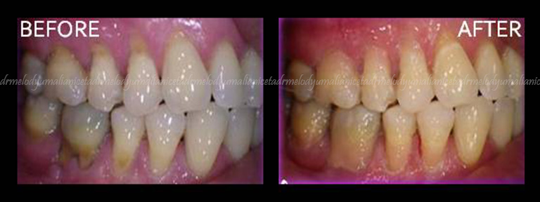 Dental Restoration 3