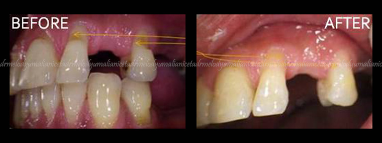 Dental Restoration 4