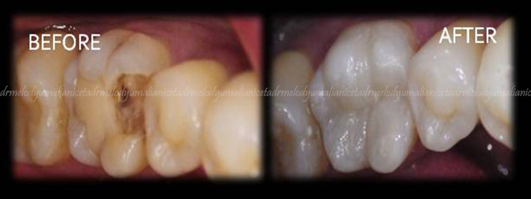 Dental Restoration 5