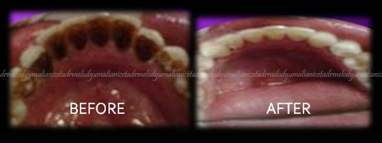 Oral Prophylaxis / Stain Removal 2