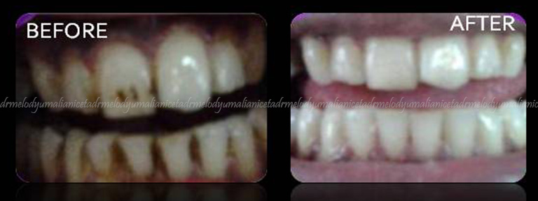 Oral Prophylaxis / Stain Removal 3