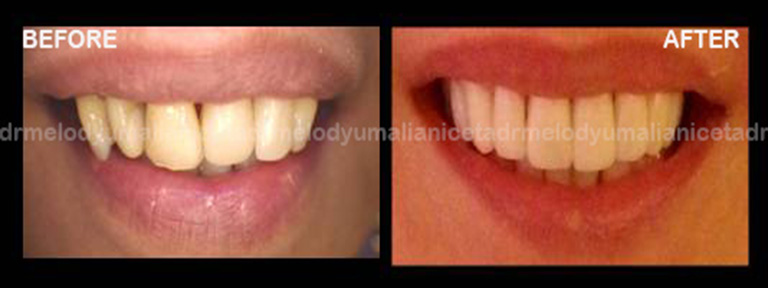 Emax Veneers 2