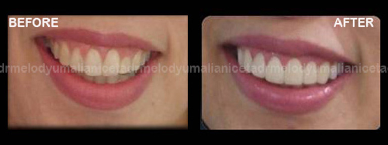 Emax Veneers