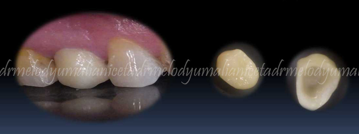 Zirconia CROWN