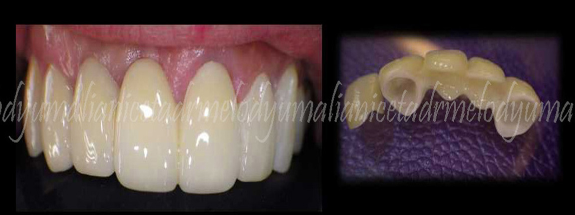 Zirconia and Emax