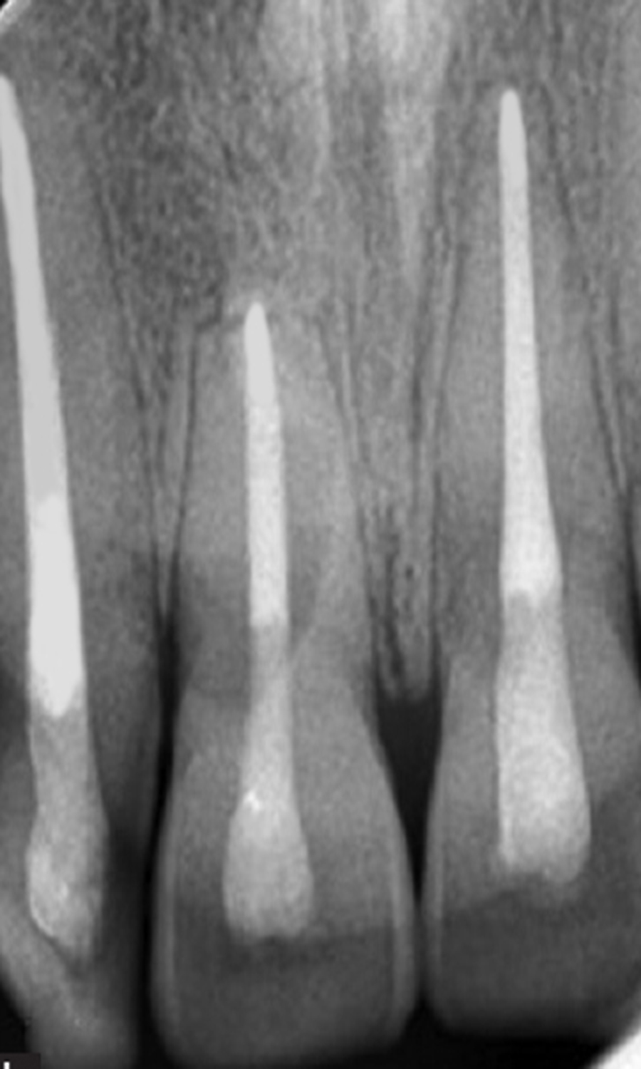 Anterior Root Canal Treatment