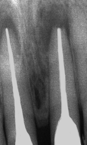 Anterior Root Canal Treatment