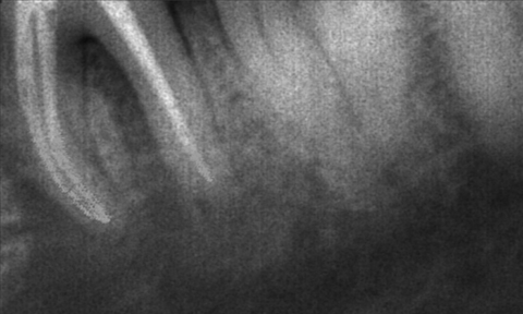 Posterior Root Canal Treatment