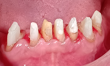 Root Canal with Fiber Post