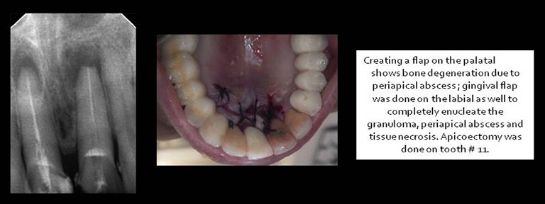 Gingival and Palatal Flap with Apicoectomy