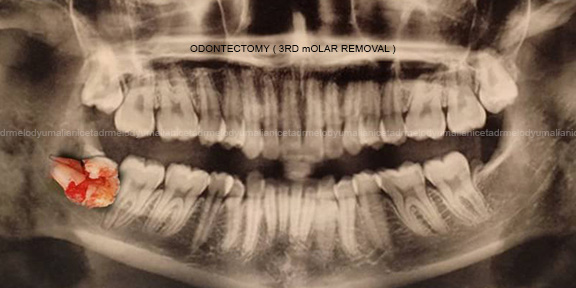 Odontectomy