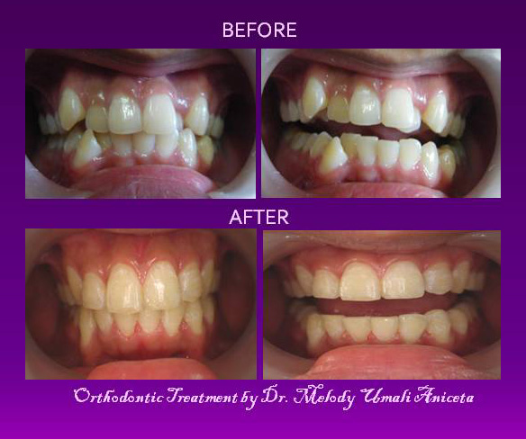 Orthodontic Treatment 1