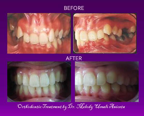 Orthodontic Treatment 4