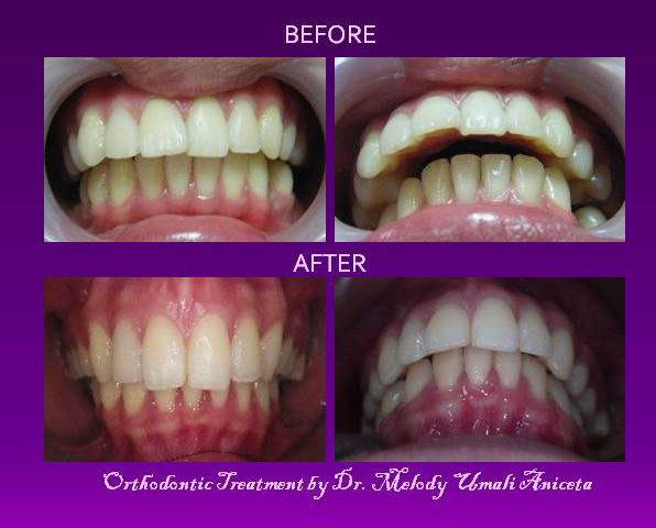 Orthodontic Treatment 2