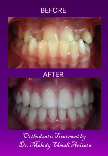 Orthodontic Treatment 10