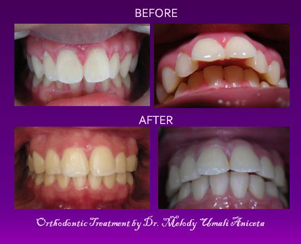 Orthodontic Treatment 5