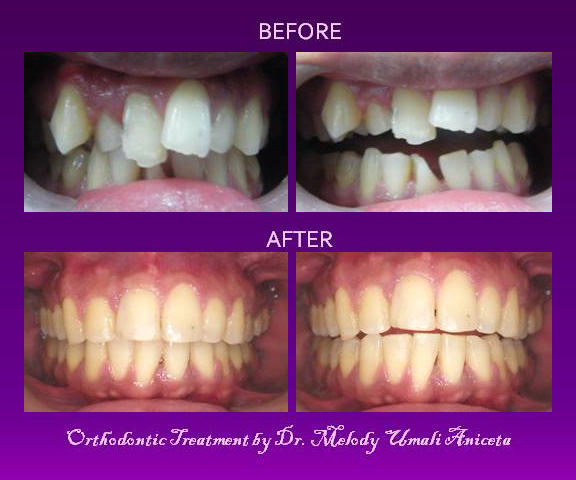 Orthodontic Treatment 6