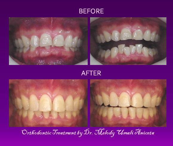 Orthodontic Treatment 7