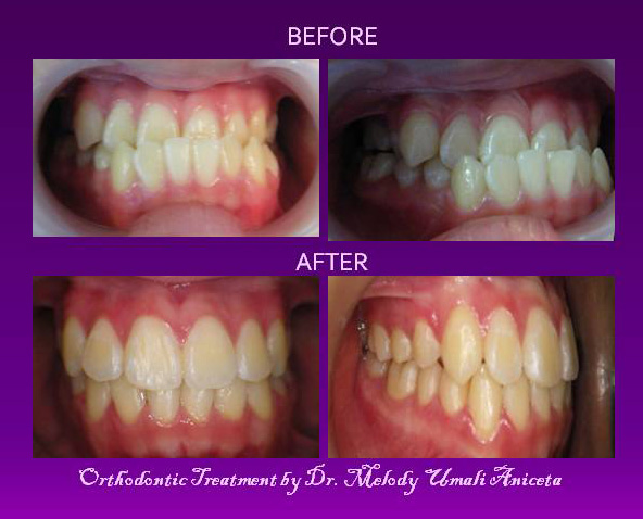 Orthodontic Treatment 8