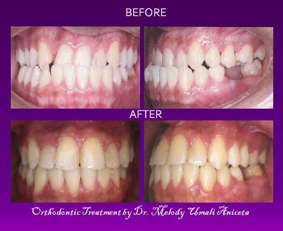 Orthodontic Treatment 9