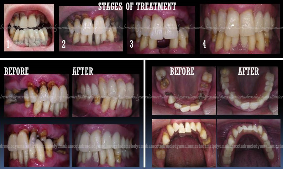 Generalized Periodontal Treatment