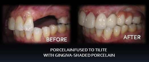 Porcelain Fused to Tilite with Gingiva-Shaded Porcelain