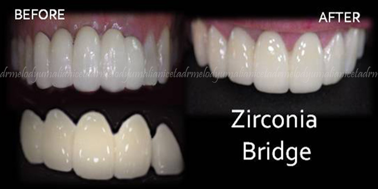 Zirconia Bridge