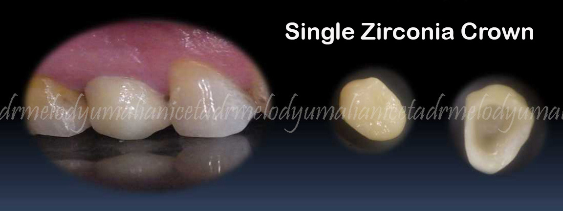 Zirconia CROWN