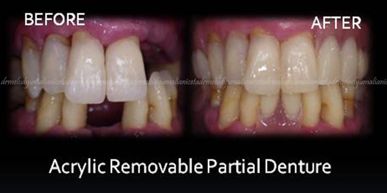 Acrylic Removal Partial Denture