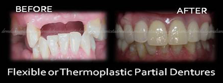 Flexible or Thermaplastic Removable Partial Denture