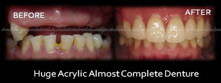 Huge Acrylic Almost Complete Denture