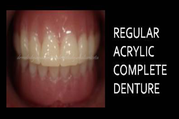 Regular Acrylic Complete Denture