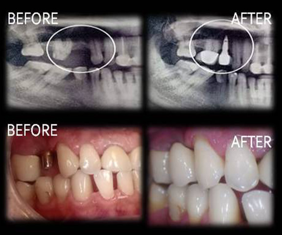 Implant2