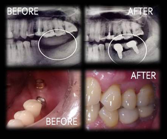 Implant3