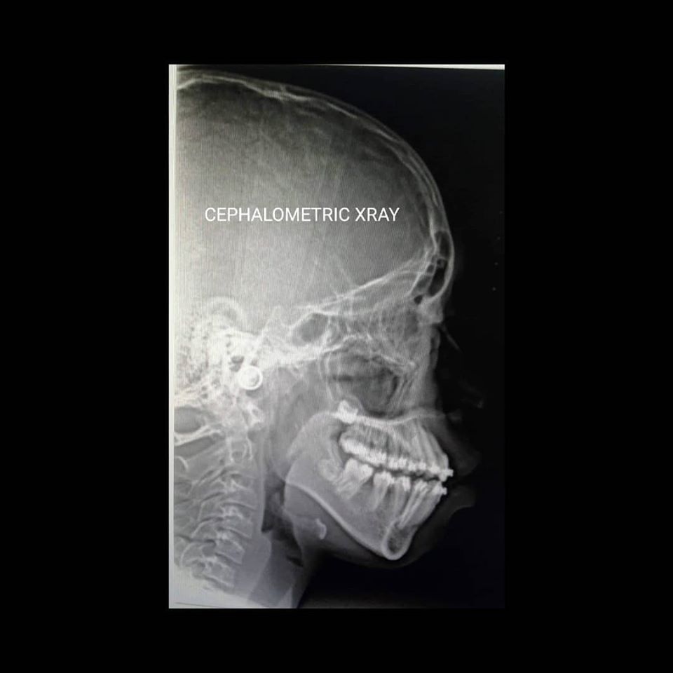 Cephalometric X-ray