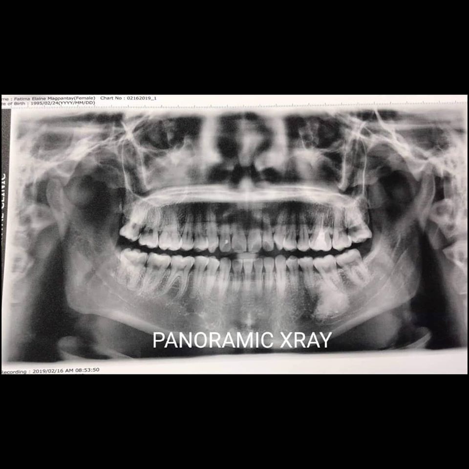 Panoramic X-ray