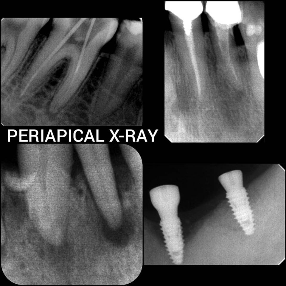 Periapical X-ray